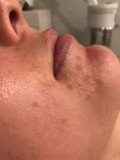 Acne treatment before
