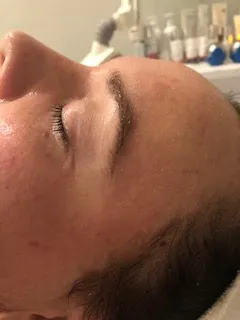 after Corrective skincare treatment