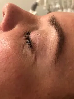 before Corrective skincare treatment