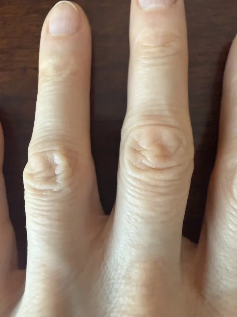 Dyshidrotic Eczema after Functional Medicine