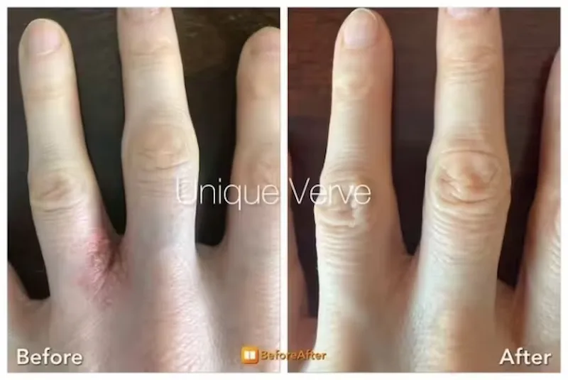 Dyshidrotic eczema before and after functional medicine — client hands showing severe dyshidrotic eczema before treatment and clear skin after three months of Unique Verve functional medicine program addressing toxic burden gut health and nutrient repletion