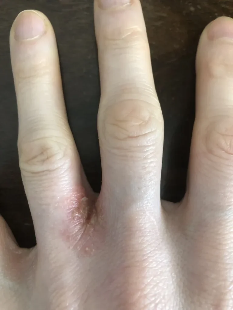 Dyshidrotic Eczema Before Functional Medicine