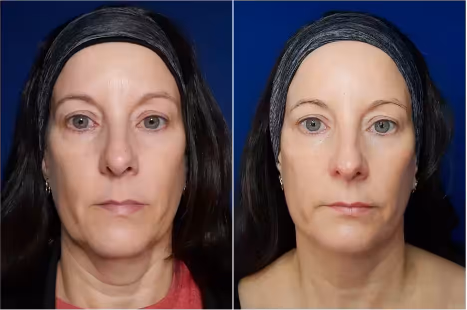 Environ DF Vitamin Infusion Filler Neck