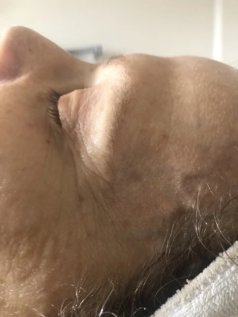 After anti-aging skincare treatment