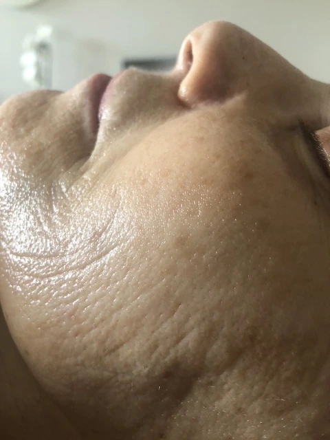 After skin rejuvenation facial treatment