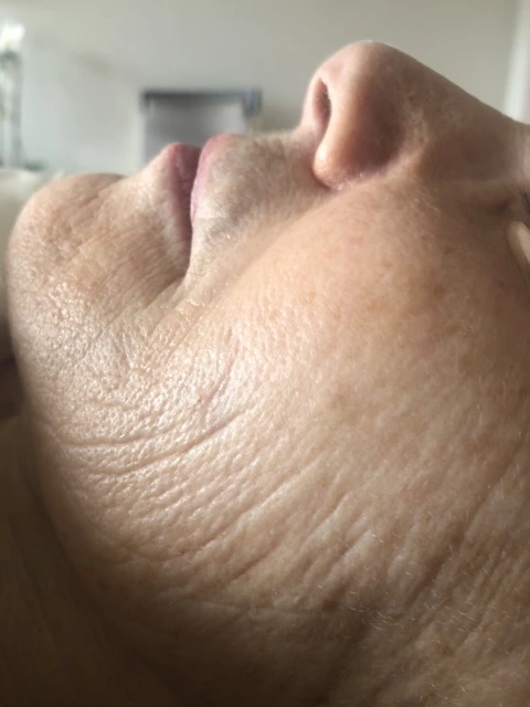 Before skin rejuvenation facial treatment