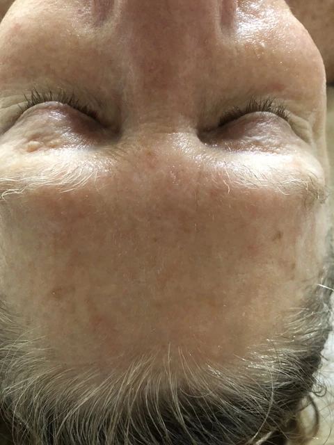 After under-eye skincare treatment