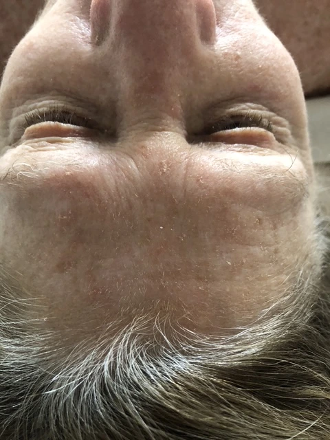 Before under-eye skincare treatment