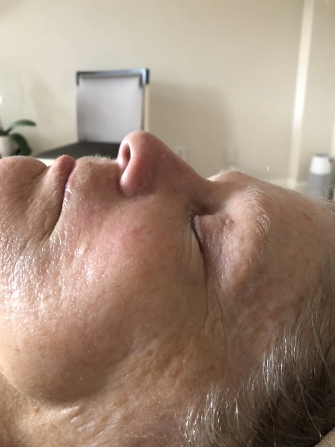 After professional facial treatment results