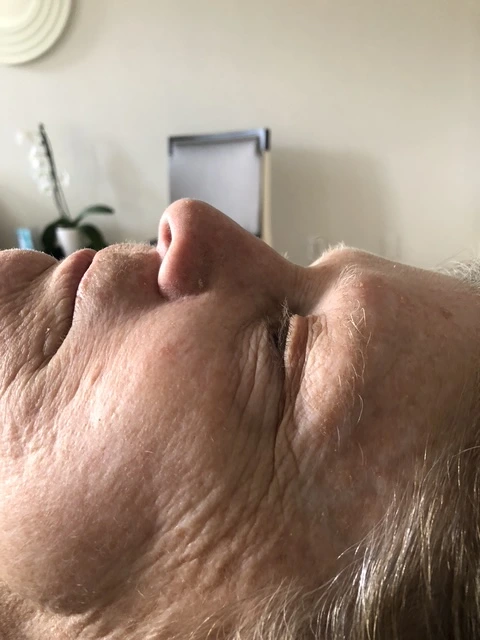 Before professional facial treatment results