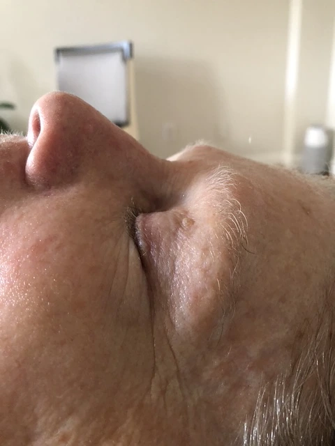 After skin rejuvenation treatment
