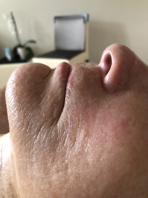 After professional facial treatment
