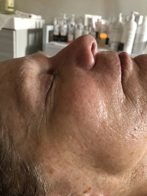 After anti-aging skincare treatment