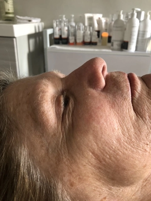 Before anti-aging skincare treatment
