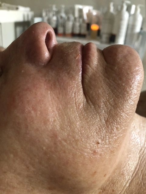 After skin texture treatment results