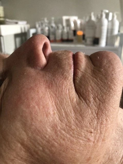 Before skin texture treatment results