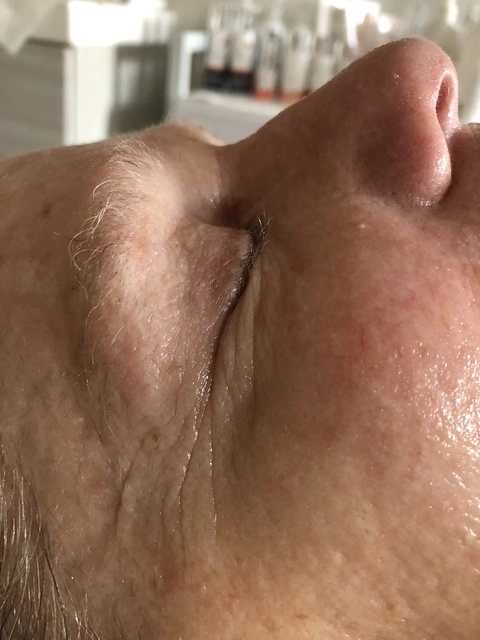After facial skincare treatment results