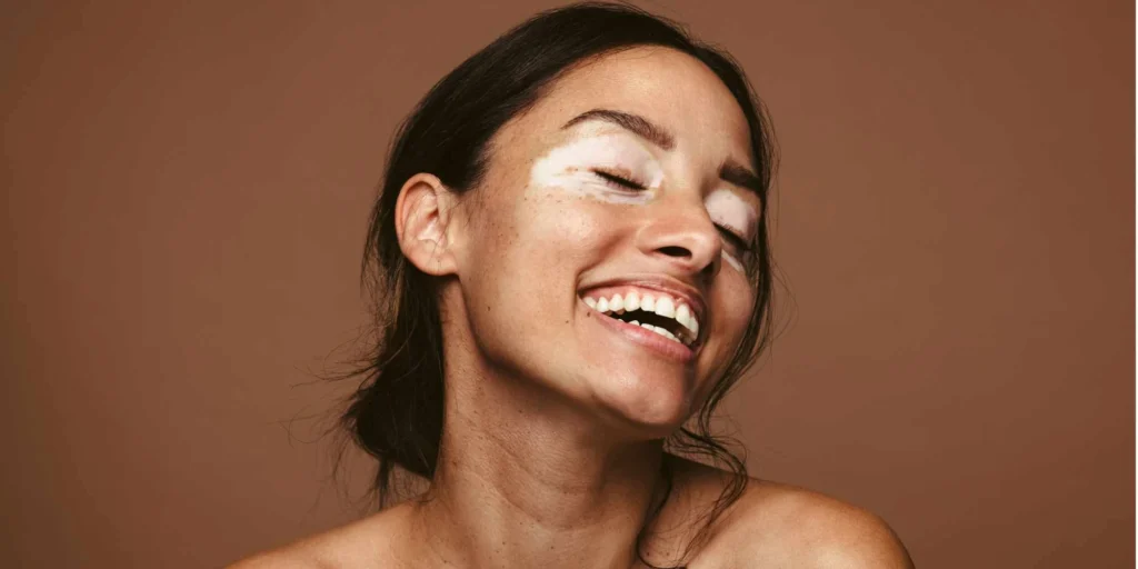 functional medicine vitiligo treatment